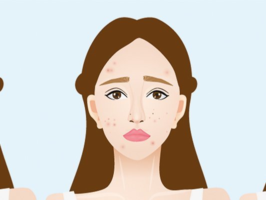 Creme aus Propolis, Teebaumöl und Aloe vera als  Alternative zu Erythromycin Creme für bessere Bekämpfung von Akne 