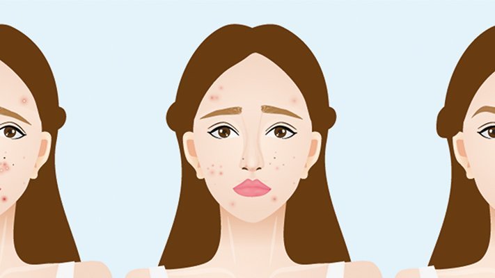 Carstens-Stiftung: Natürliches Trio gegen Akne Creme aus Propolis, Teebaumöl und Aloe vera als Alternative zu Erythromycin Creme für bessere Bekämpfung von Akne