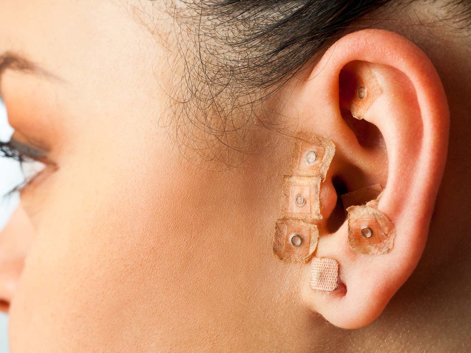 Lindern semipermanente Nadeln im Ohr depressive Symptome?