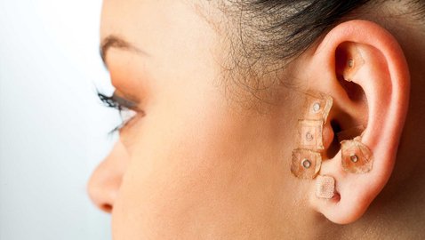 Lindern semipermanente Nadeln im Ohr depressive Symptome?