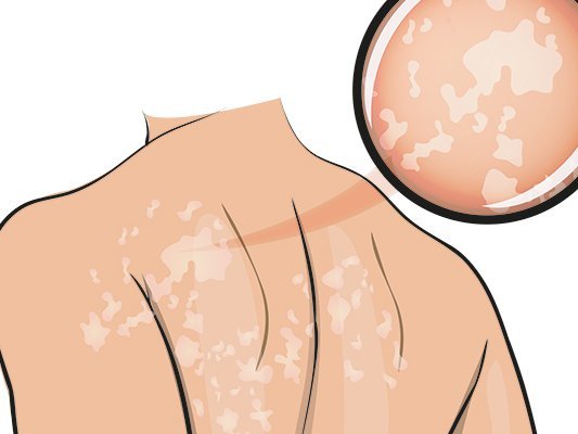 Carstens-Stiftung: Pflanzencocktail gegen Hautpilz?