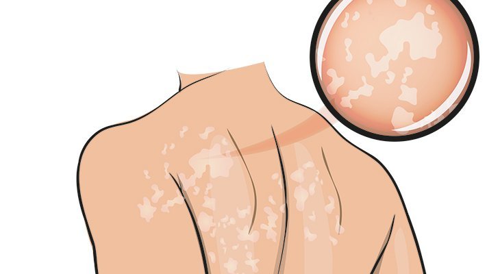 Carstens-Stiftung: Pflanzencocktail gegen Hautpilz? Carstens-Stiftung: Pflanzencocktail gegen Hautpilz?