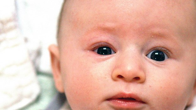 Lidrandentzündung durch Parasiten Carstens-Stiftung: Lidrandentzündung, Blepharitis, Parasiten