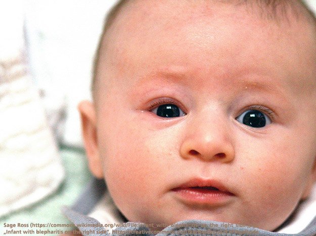 Lidrandentzündung durch Parasiten Carstens-Stiftung: Lidrandentzündung, Blepharitis, Parasiten