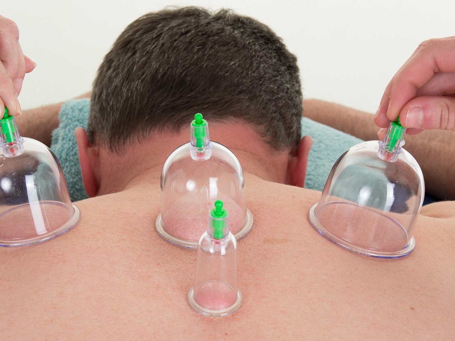 Der Effekt von nassem Schröpfen bei Asthma im Erwachsenenalter