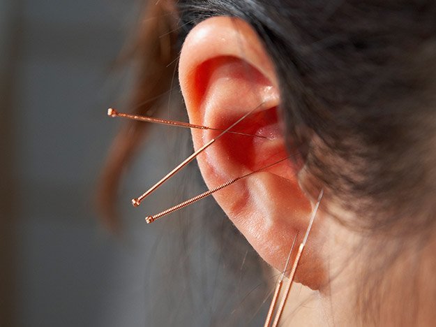 Ohrakupunktur bei Schlafstörungen Carstens-Stiftung: Ohrakupunktur bei Schlafstörungen