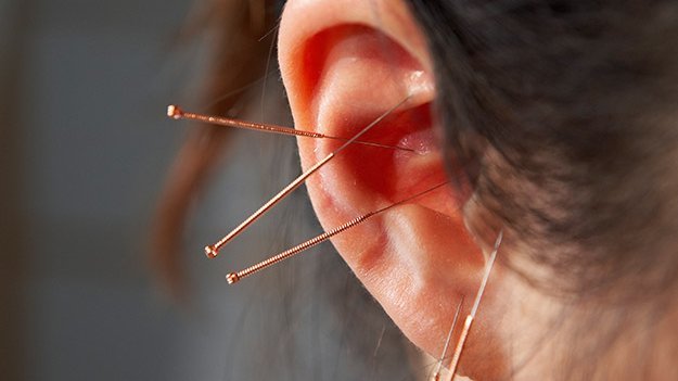 Ohrakupunktur bei Schlafstörungen Carstens-Stiftung: Ohrakupunktur bei Schlafstörungen