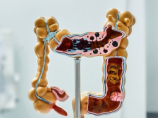 Morbus Crohn – Stressreduktions- und Lebensstilmodifikations-Programm