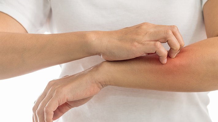 Carstens-Stiftung: Natürliche Behandlung der Schuppenflechte Carstens-Stiftung: Natürliche Behandlung der Schuppenflechte