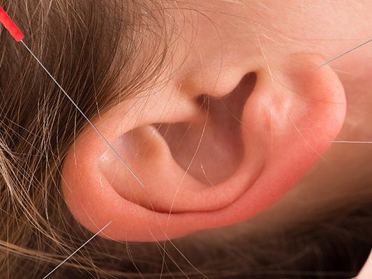 Lindert Akupunktur chronische Schmerzen bei Krebsüberlebenden?