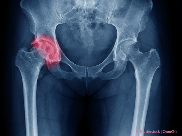 Weniger Knorpelabbau auf natürlichem Carstens-Stiftung: Weniger Knorpelabbau auf natürlichem Wege?